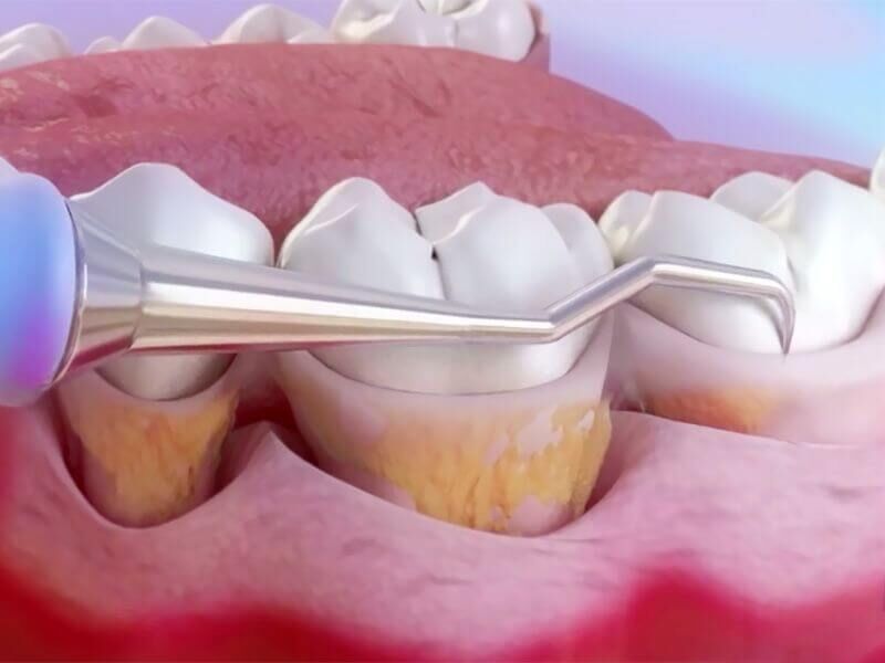 Udalenie zubnogo kamnya