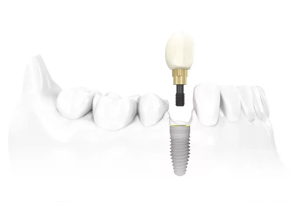 Odnomomentnaya implantaciya zubov