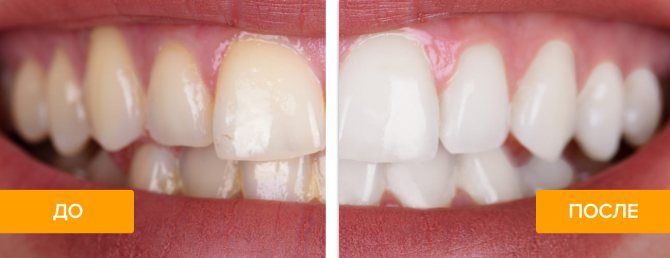 Отбеливание зубов Zoom 4 в стоматологии DrShorbatov