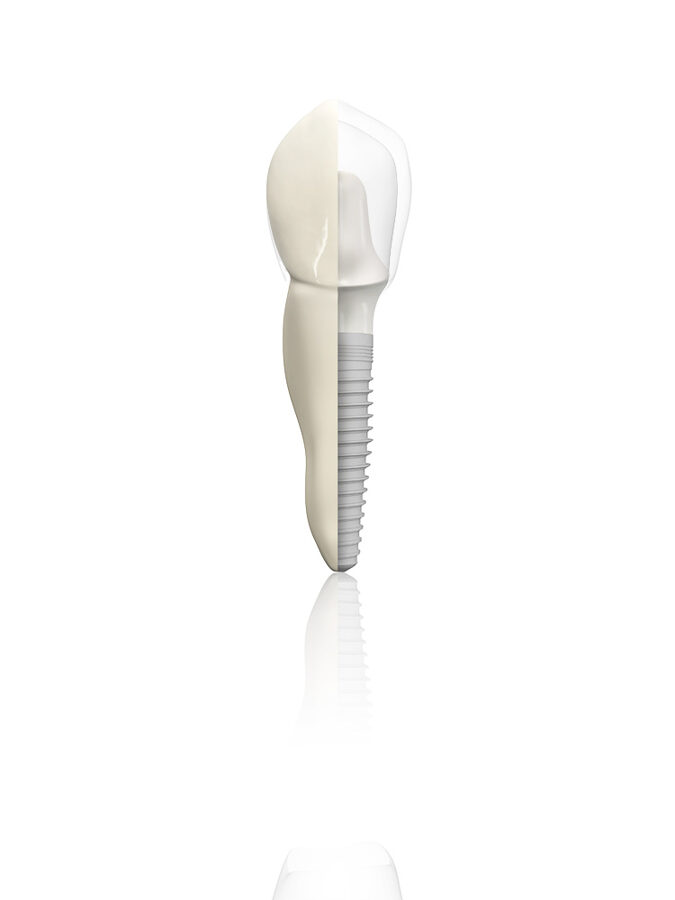 Implant i koronka zuba